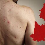¿Hay casos de sarampión en Puebla? Esto es lo que sabemos